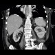 Pachypleuritis, calcified, pachypleuritis calcarea: CT - Computed tomography